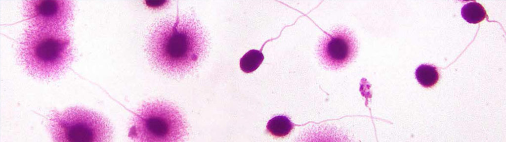 Frammentazioni DNA spermatico