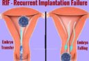 Ruolo immunologico delle interleuchine nel fallimento ripetuto di impianto